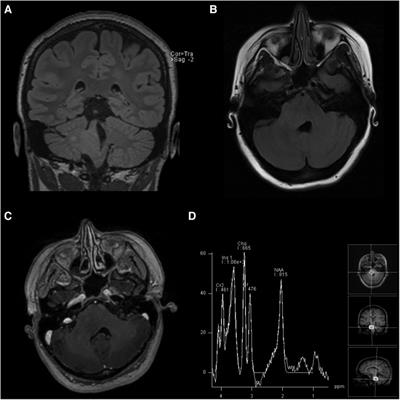 Case Report: Low-grade glioma with NF1 loss of function mimicking diffuse intrinsic pontine glioma